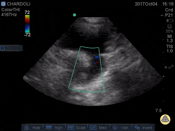 Pediatrics - Ductus Arteriosus (Patent)