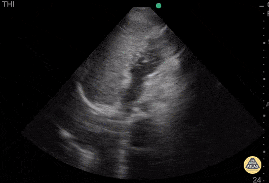 Pediatrics - Atrial Septal Defect, Positive Bubble Test