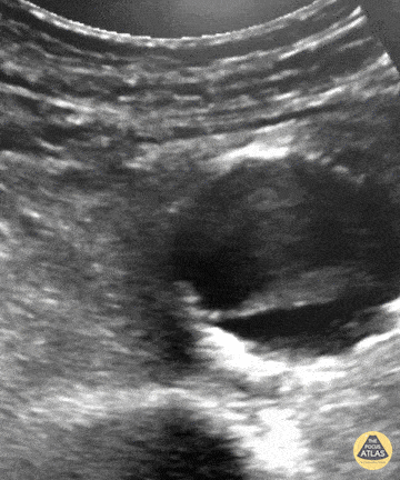 Aorta - Pulsating Aortic Aneurysm