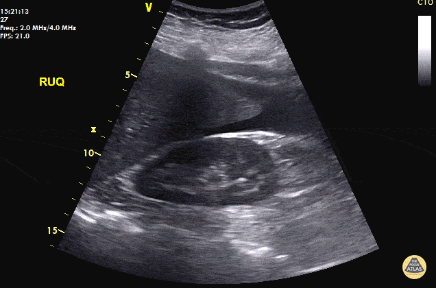 OB/Gyn - Positive FAST - Ruptured Ectopic