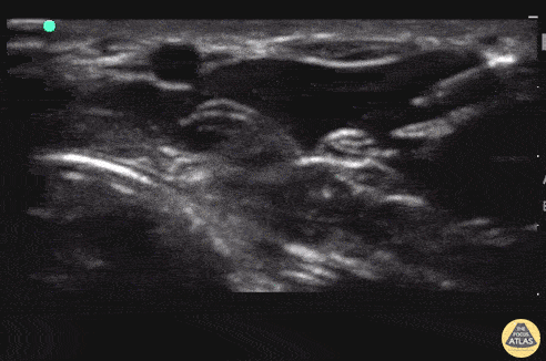 Nerve Block Gallery - Median Nerve Block