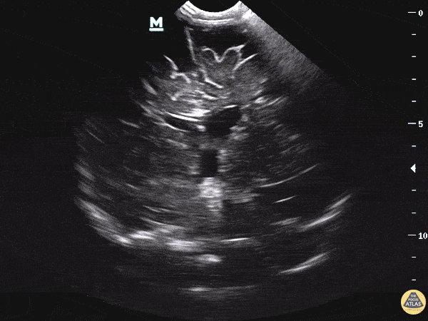 Pediatrics - Obstructive Hydrocephalus