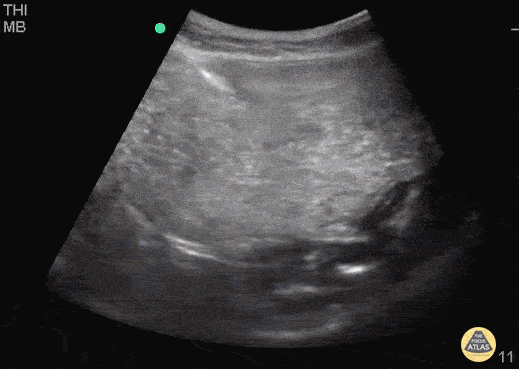 Bowel-GI - Gastric Volvulus