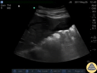 Trauma - Positive FAST - RUQ