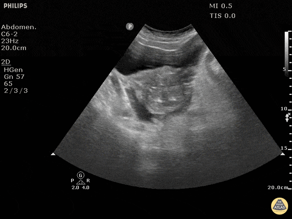 Trauma - Positive FAST Pelvis - Transverse