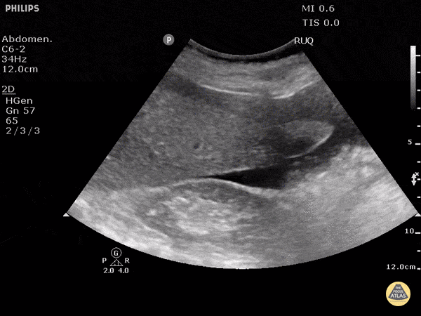 Trauma - Positive FAST - RUQ - Morison's Pouch
