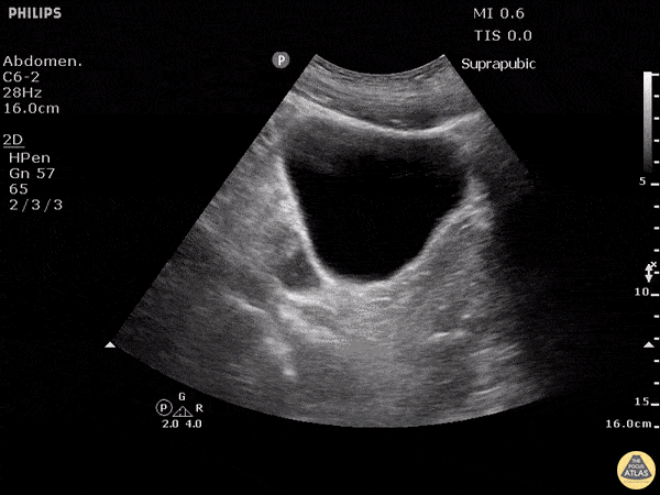 Trauma - Positive FAST - Pelvis Transverse