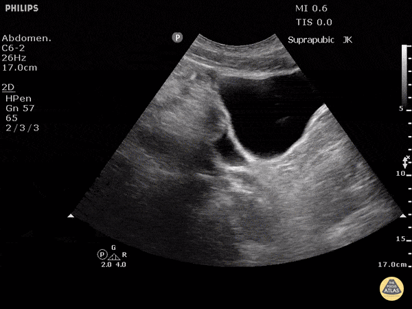 Trauma - Positive FAST - Pelvis - Sagittal