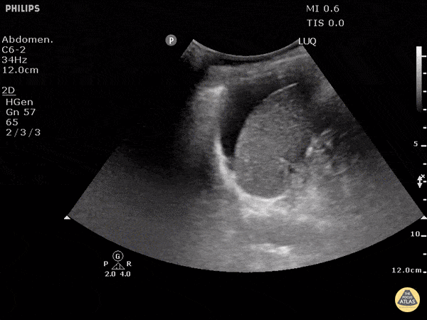 Trauma - Positive FAST - LUQ