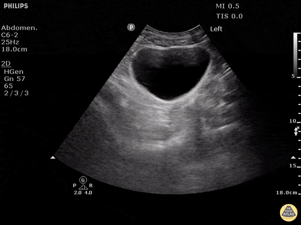 Trauma - Normal FAST - Pelvis - Transverse
