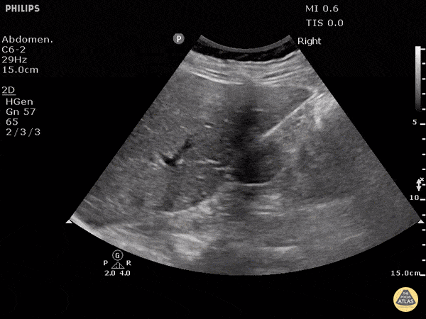 Trauma - Normal FAST - RUQ