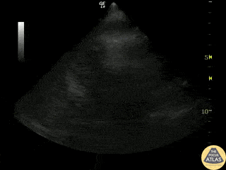 Trauma - Normal FAST - LUQ