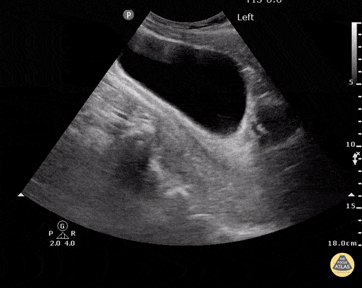 Trauma - Normal FAST - Pelvis - Sagittal