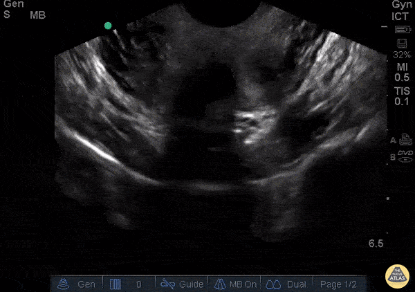 OB/Gyn - Bicornuate Uterus with IUP
