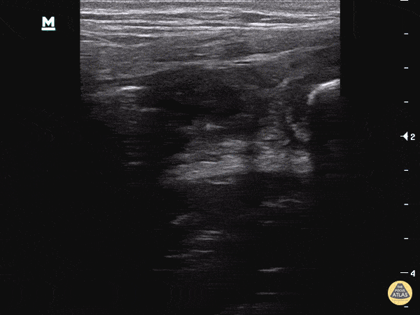 Bowel-GI - Appendicitis with two fecaliths