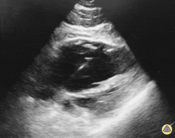 Other Cardiac Pathology - Transvenous Pacemaker Guidance
