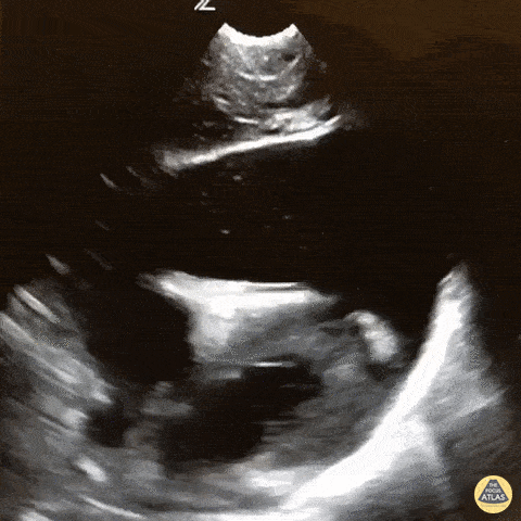 Pericardial Disease - Acute Traumatic Cardiac Tamponade