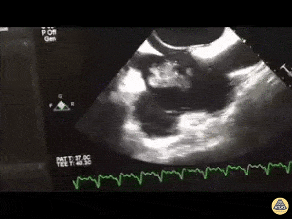 Other Cardiac Pathology - Thrombus in Transit