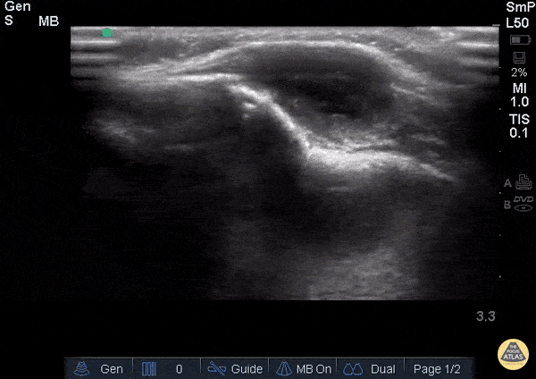 Soft Tissue - Facial Tumor