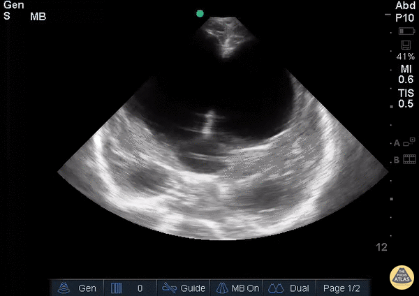 Pediatrics - Hydrocephalus