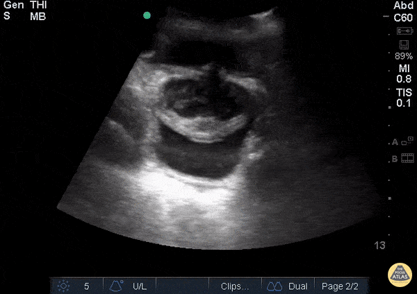 Pediatrics - Ureterocele