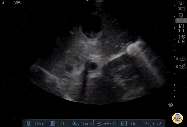 Bowel-GI - Hepatic Lesions (Incidental)