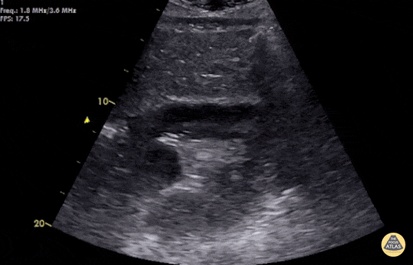 EA Echo Examples - Positive FAST - Tamponade