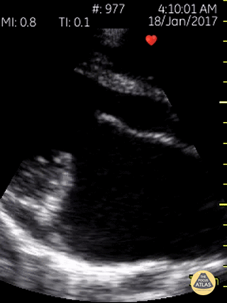 Valvulopathy - Hockey Stick Sign