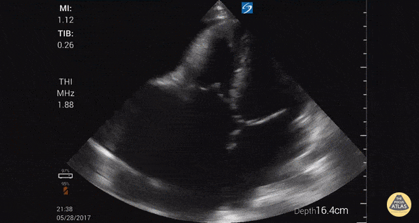Right Ventricular Dysfunction - Right-Sided Heart Failure