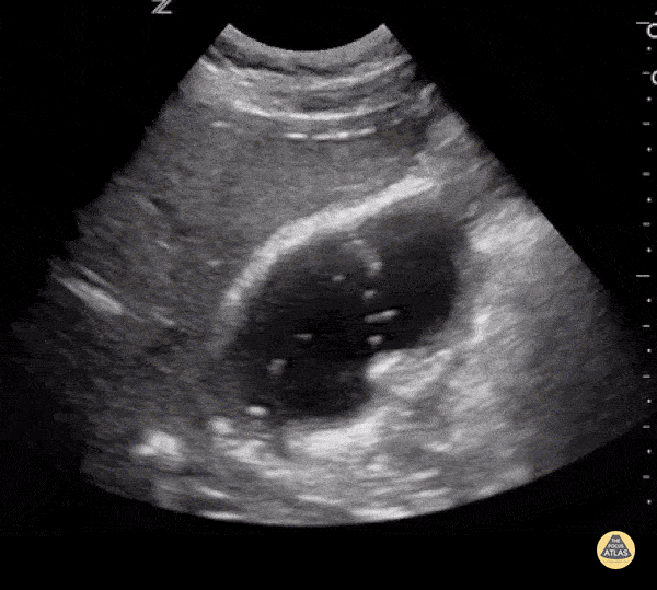Bowel-GI - Duodeno-Biliary Fistula