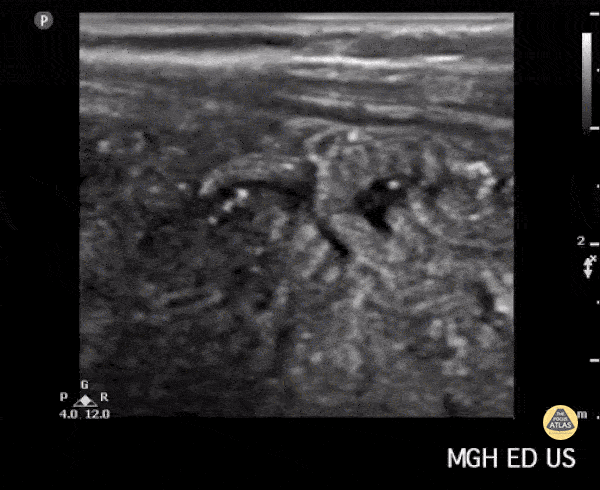 Peds-Gastrointestinal - Ascariasis - "Sqworming in your belly is just ascaris as it sounds"