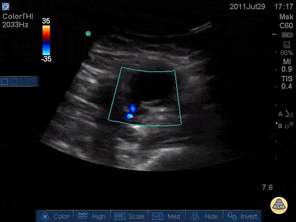Vascular - Pseudoaneurysm - "Thar She Blows"