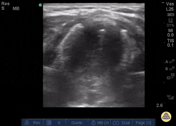 Pediatrics - Tracheal Stenosis