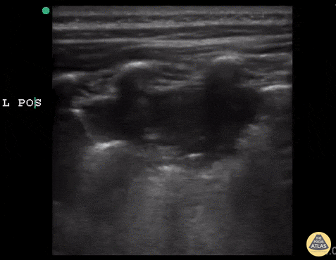 Pediatrics - Acute Chest Syndrome
