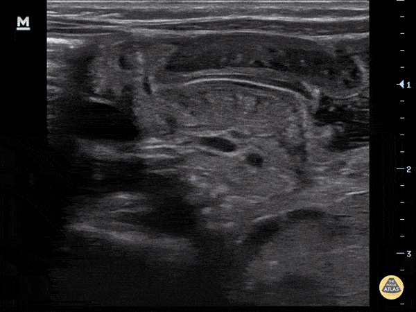 Peds-Gastrointestinal - Pyloric Stenosis (Longitudinal)