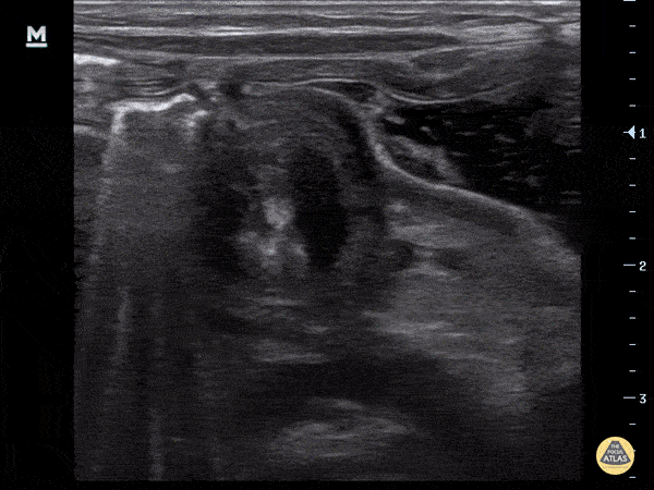 Peds-Gastrointestinal - Pyloric Stenosis (Transverse)