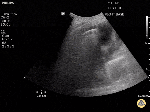 Pulmonary - B-lines and Effusion