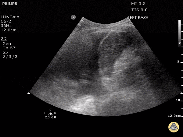 Pulmonary - Large Pleural Effusion