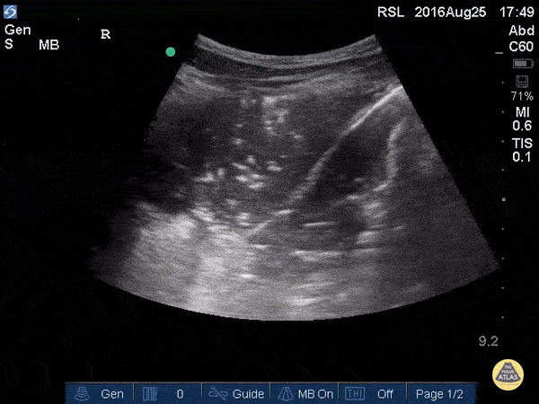 Pulmonary - Lung Consolidation with Mirror Artifact