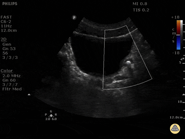 Renal/GU - The Twinkle Artifact