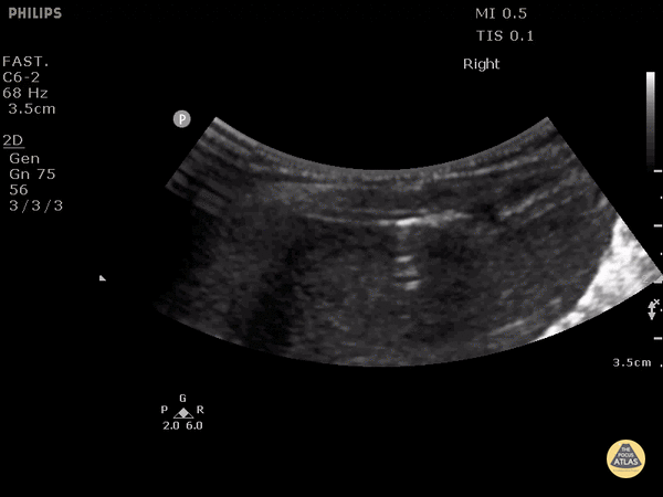 Trauma - Traumatic Pneumoperitoneum (1/2)