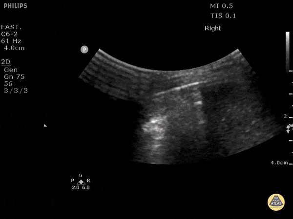 Trauma - Traumatic Pneumoperitoneum (2/2)