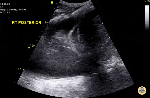 Pulmonary - Jellyfish Sign