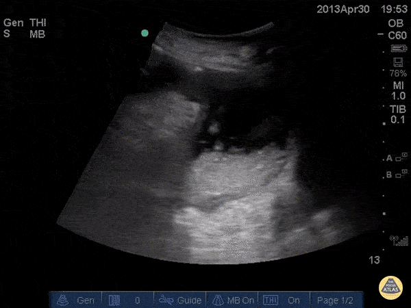 Bowel-GI - Iguapoo Falls