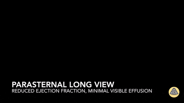 Left Ventricular Dysfunction - Takotsubo's Cardiomyopathy