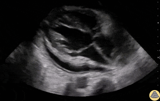 Pericardial Disease - Cardiac Tamponade