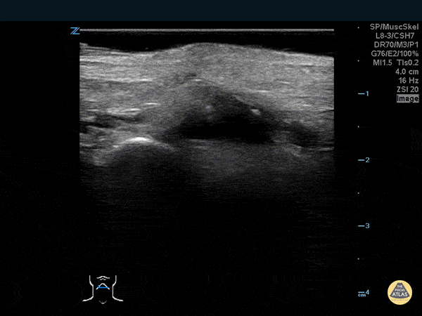 Musculoskeletal - Thumb Fracture
