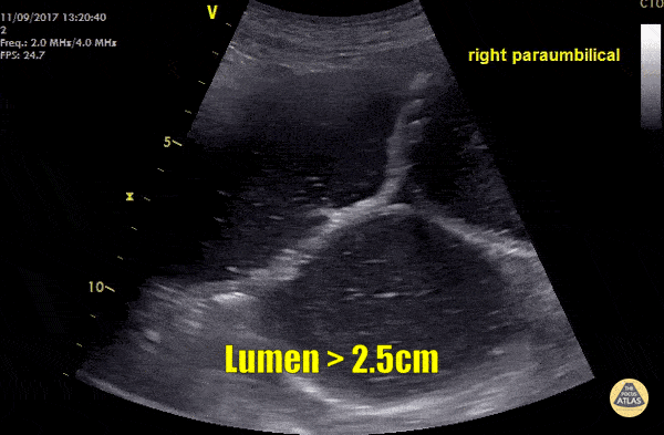 Bowel-GI - Small Bowel Obstruction
