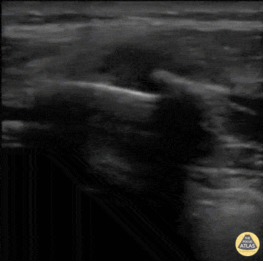 Musculoskeletal - Rib Fracture