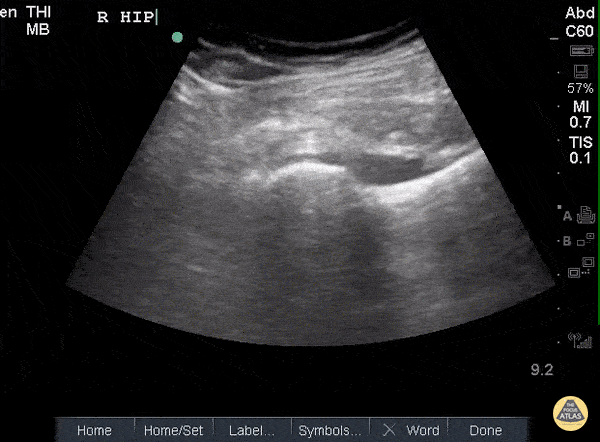 Musculoskeletal - Hip Effusion